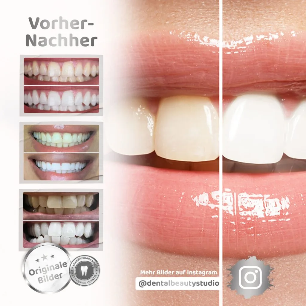 Vorher-nachher-Bilder mit dem Zahnbleaching-Set Rapid+