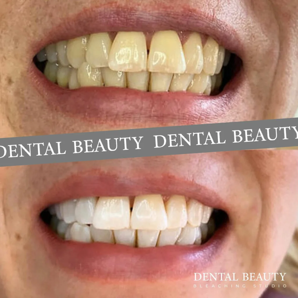 Vorher-nachher: kosmetisches Bleaching bei Dental Beauty, Ergebnis 1
