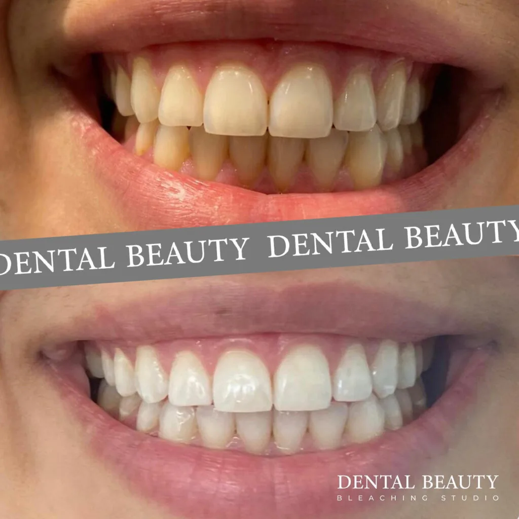 Vorher-nachher: kosmetisches Bleaching bei Dental Beauty, Ergebnis 2