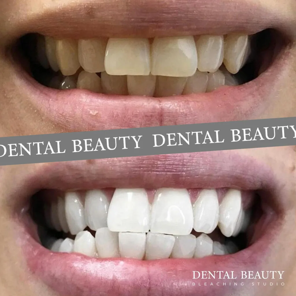 Vorher-nachher: kosmetisches Bleaching bei Dental Beauty, Ergebnis 3