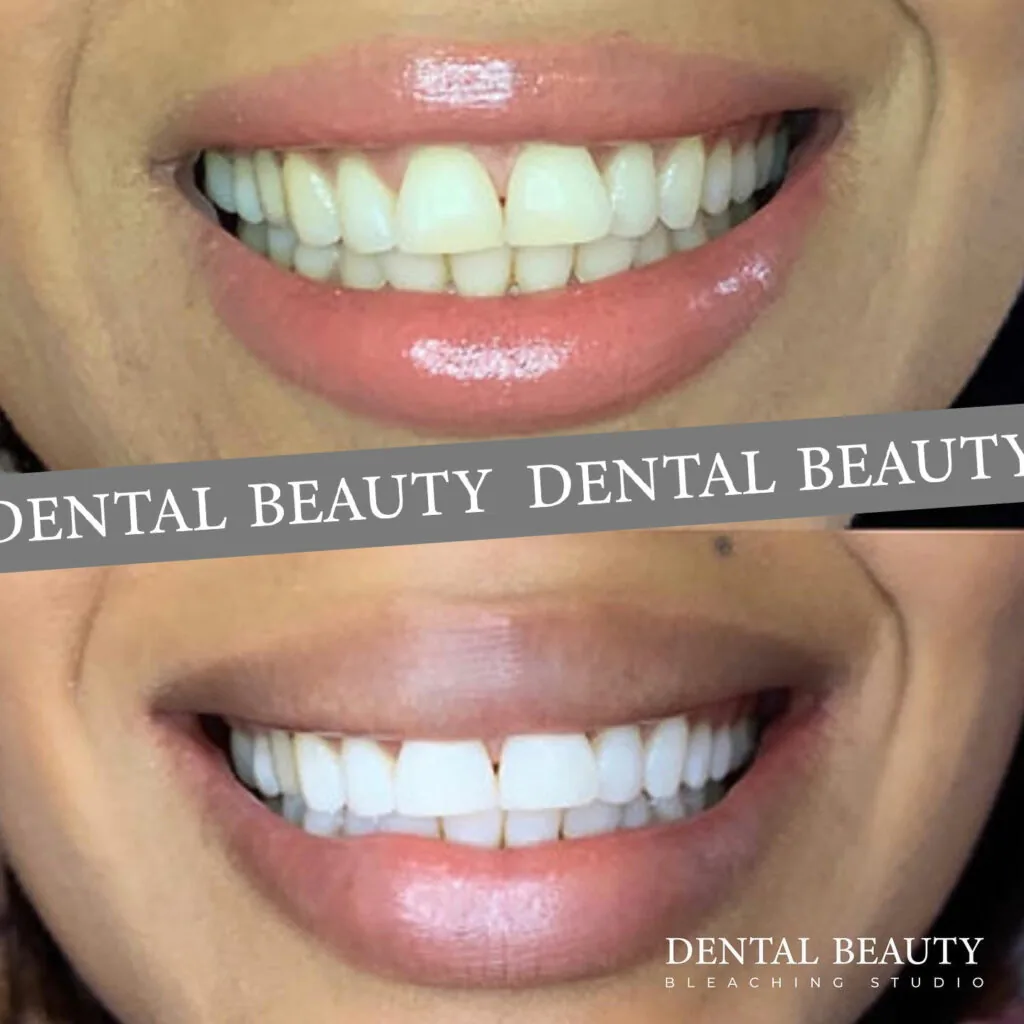 Vorher-nachher: kosmetisches Bleaching bei Dental Beauty, Ergebnis 4