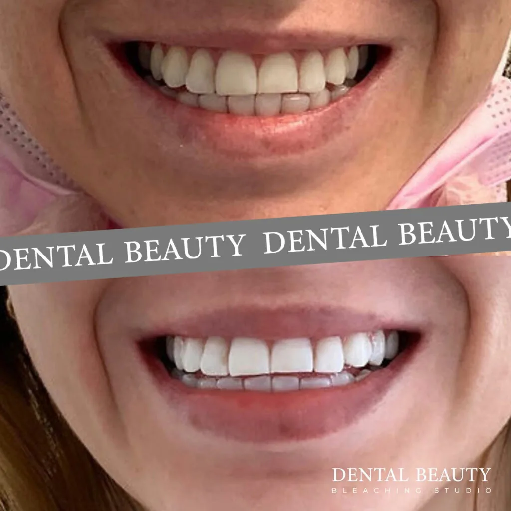 Vorher-nachher: kosmetisches Bleaching bei Dental Beauty, Ergebnis 5