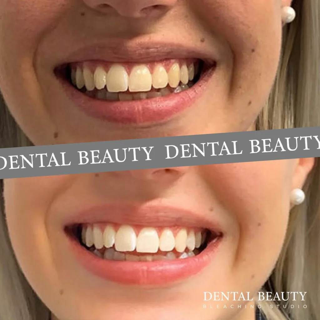 Vorher-nachher: kosmetisches Bleaching bei Dental Beauty, Ergebnis 6