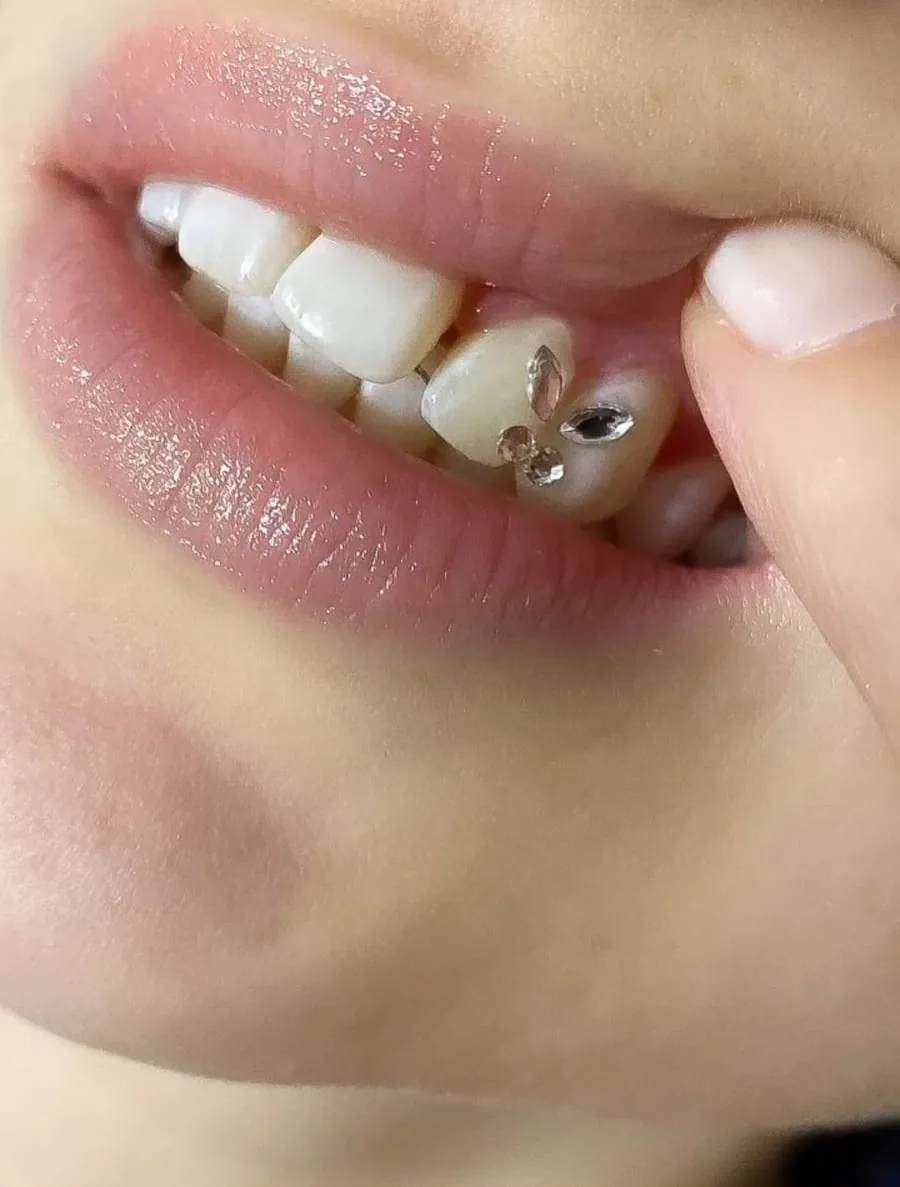 Funkelnder Strass-Stein auf einem Zahn